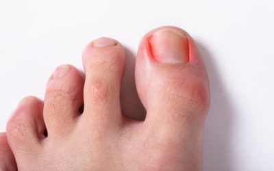 What Should You Expect from Ingrown Toenail Surgery?