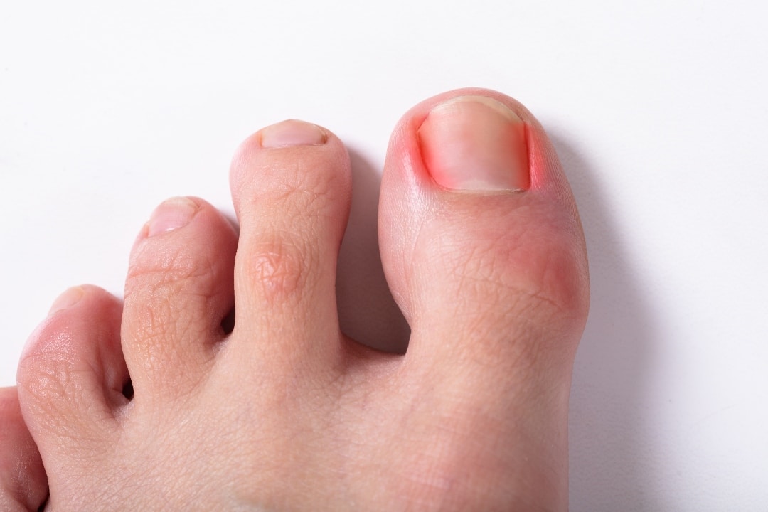 What Should You Expect From Ingrown Toenail Surgery Foot Ankle 