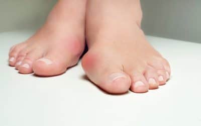 What is a Bunion (and What Can You Do About It)?